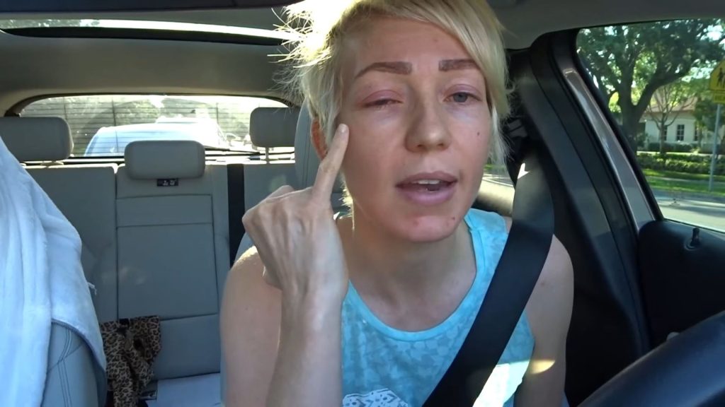 Permanent Makeup Eyeliner Tattoo Gone Wrong